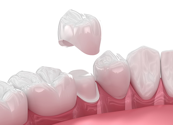 セラミッククラウン