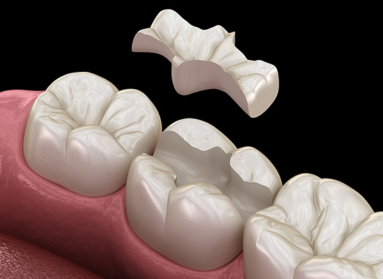 セラミックインレー