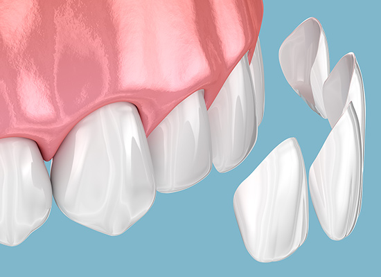 ラミネートベニア